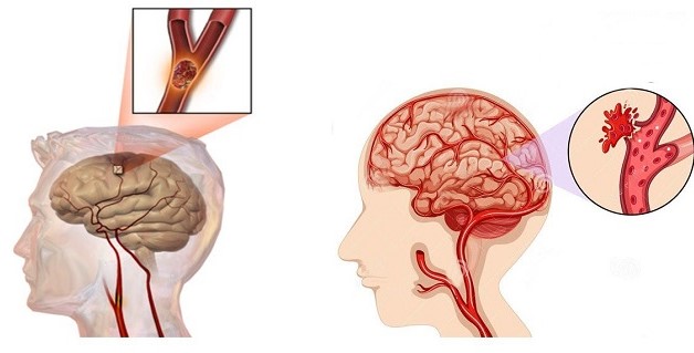 Tai biến mạch máu não có mức độ nguy hiểm thế nào?