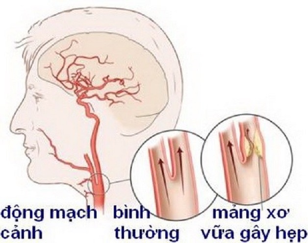 Tai biến mạch máu não là gì? Dấu hiệu và nguyên nhân