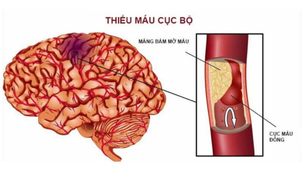 Tai biến mạch máu não: Những nguy hiểm khó lường