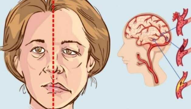 Tai biến mạch máu não: “Thủ phạm” cướp đi tính mạng nhiều người