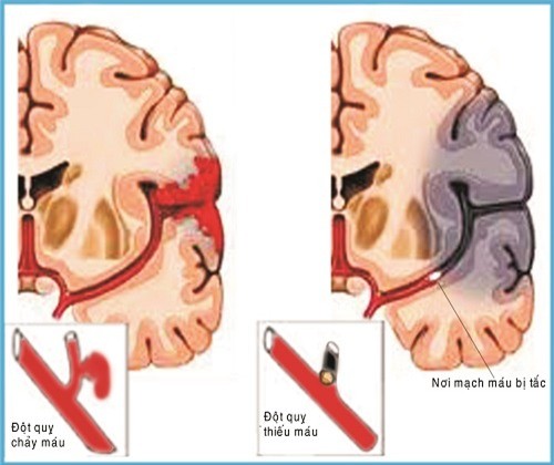 Tai biến mạch máu não và cách điều trị
