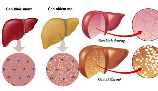 Tại sao bị gan nhiễm mỡ ở mức độ nhẹ khi lượng mỡ thấp