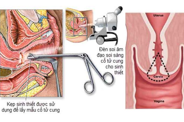 Tại sao cần thực hiện tầm soát sớm ung thư cổ tử cung?