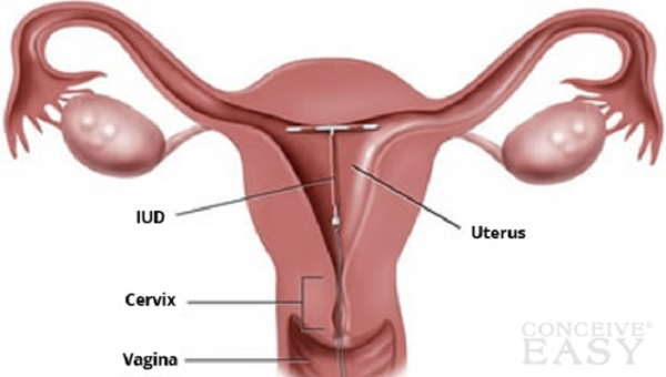 Tại sao đặt vòng xong bị đau lưng