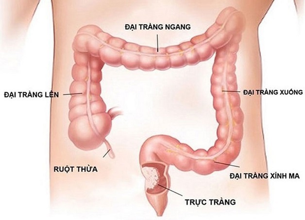 Tại sao lại viêm đại tràng? Cách điều trị