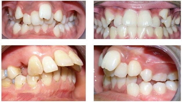 Tại sao niềng răng mắc cài kim loại vẫn được ưa chuộng 