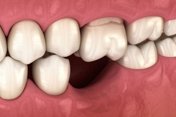 Tại sao phải cấy ghép Implant cho răng bị mất?