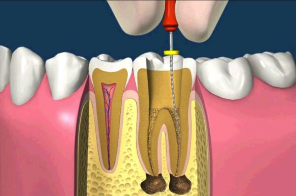 Tại sao sâu răng phải lấy tủy nhiều lần?