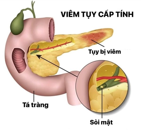 Tại sao uống rượu gây viêm tụy cấp?