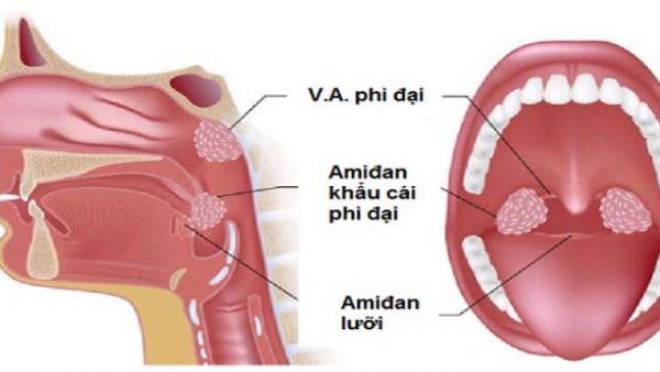 Tại sao viêm VA thường xuất hiện ở trẻ nhỏ?