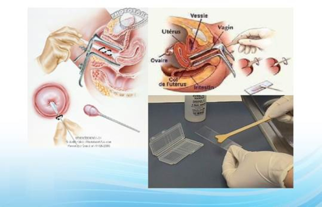 Tầm soát cổ tử cung bằng phương pháp xét nghiệm tế bào