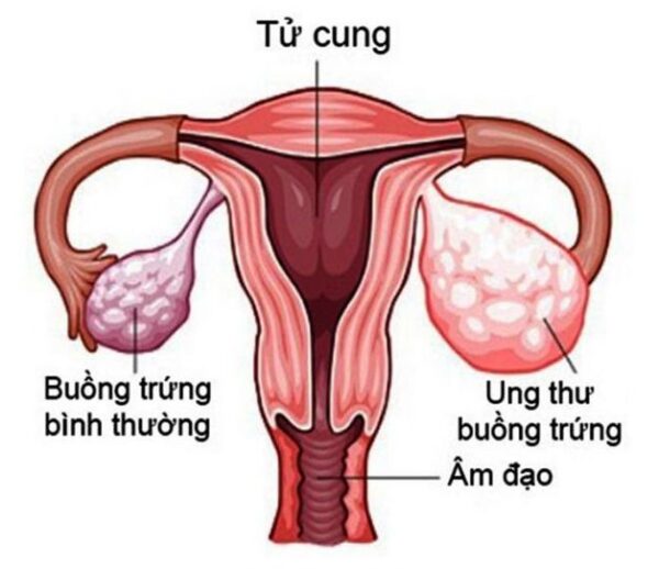 Tầm soát ung thư buồng trứng quan trọng như thế nào?