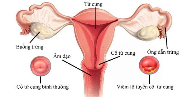 Tầm soát ung thư cổ tử cung thế nào?