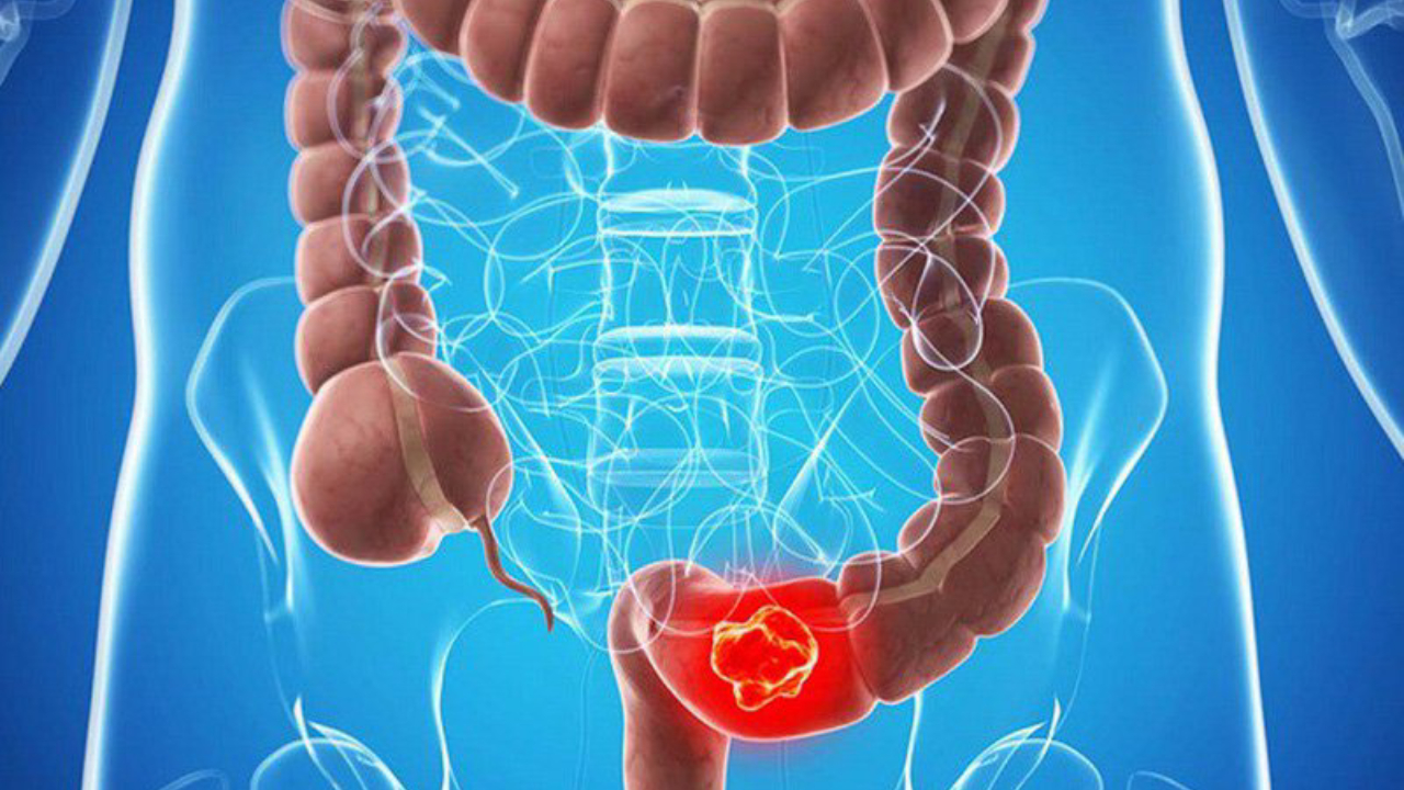 Tầm soát ung thư đại tràng bằng cách nào hiệu quả?