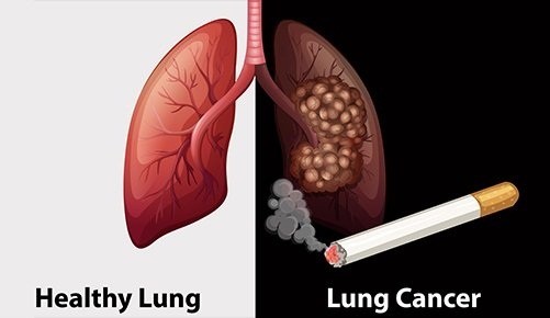 Tầm soát ung thư là gì?những thông tin cần thiết