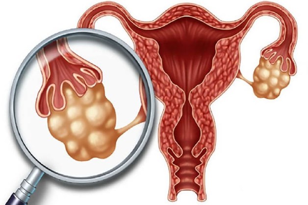 Tầm soát ung thư sớm ở nữ giới có ý nghĩa như thế nào?