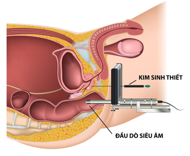 Tầm soát ung thư tiền liệt tuyến cho nam giới