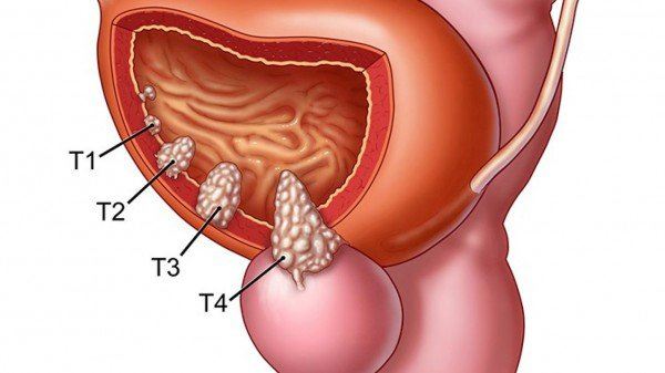 Tầm soát ung thư tiền liệt tuyến và những điều cần biết