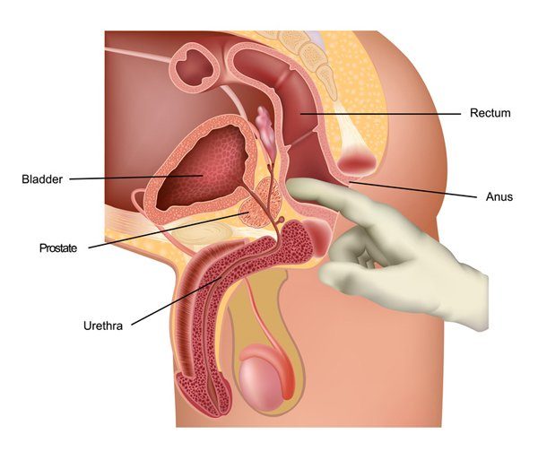 Tầm soát ung thư tuyến tiền liệt ở đâu?