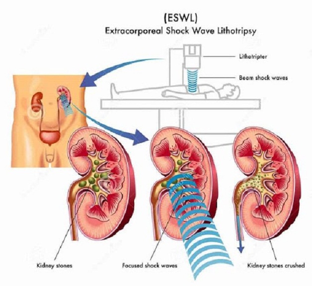 Tán sỏi ngoài cơ thể ESWL – điều trị sỏi tiết niệu không cần mổ