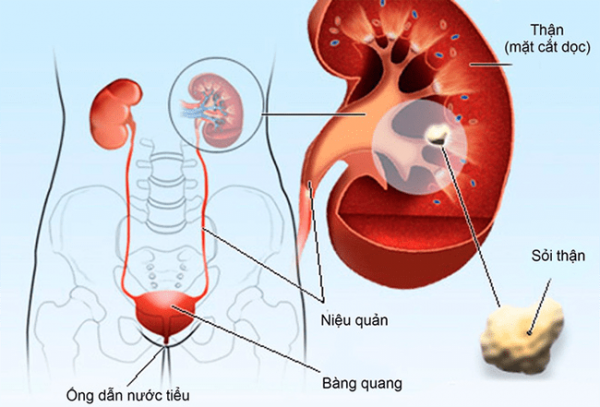 Tán sỏi ngoài cơ thể, phương pháp ưu việt đặc trị sỏi tiết niệu