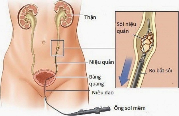 Tán sỏi ngược dòng – cuộc cách mạng trong điều trị sỏi tiết niệu