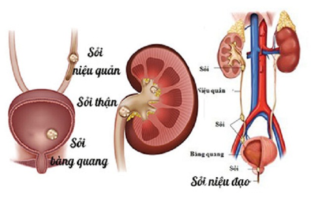 Tán sỏi niệu quản 1/3 trên được thực hiện như thế nào?