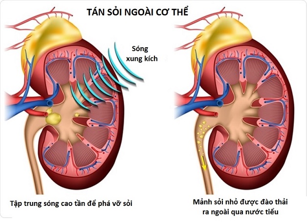 Tán sỏi niệu quản ngoài cơ thể – Điều trị sỏi không mổ