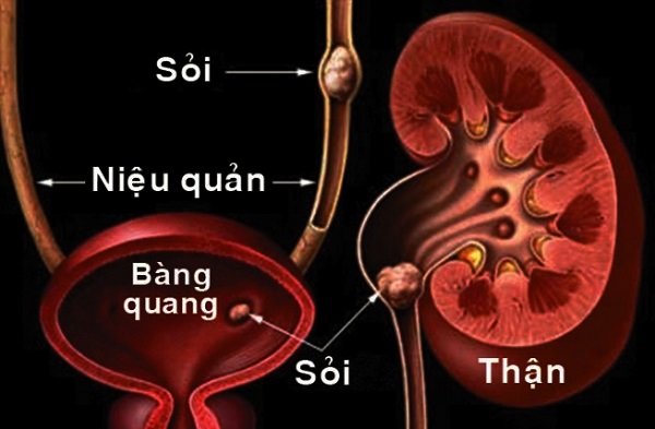 Tán sỏi niệu quản ngược dòng bằng laser là gì? 