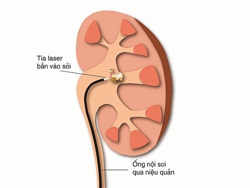 Tán sỏi nội soi ngược dòng bằng laser