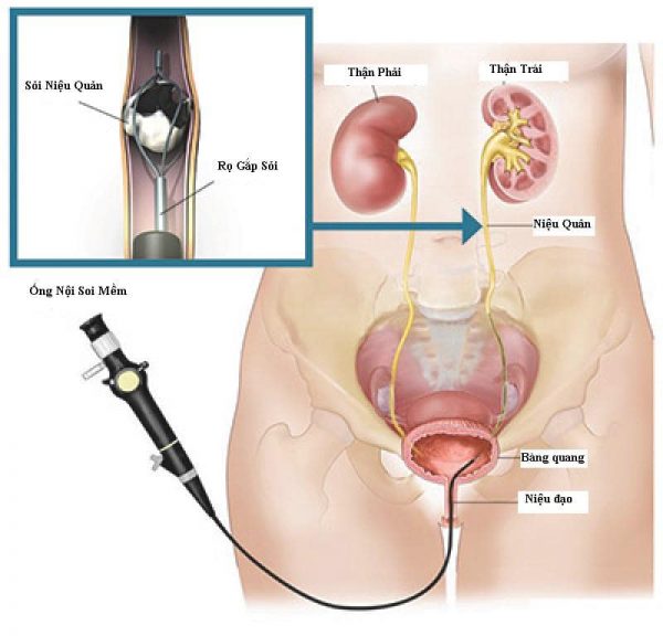 Tán sỏi nội soi ngược dòng, bước đột phá mới