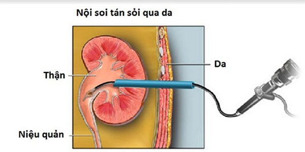 Tán sỏi qua da là phương pháp bác sĩ sẽ tạo một "đường hầm nhỏ" vào vị trí có sỏi và tán vụn sỏi bằng sóng điện từ hoặc laser (ảnh minh họa)