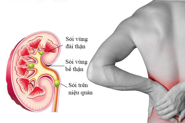 Tán sỏi qua da áp dụng cho đối tượng nào?