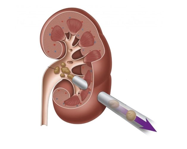 Tán sỏi qua da là gì? Đối tượng chỉ định, quy trình thực hiện