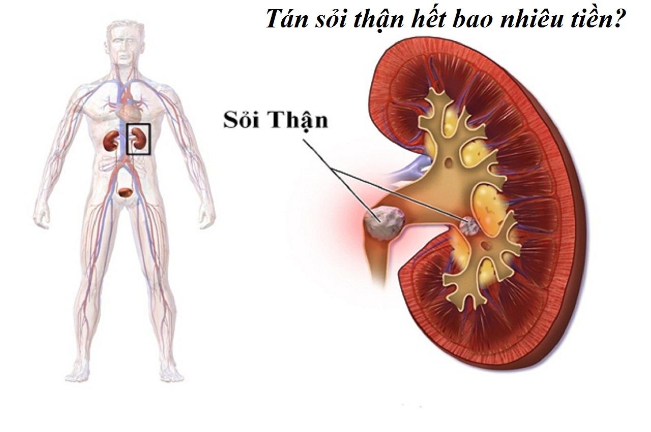 Tán sỏi thận hết bao nhiêu tiền và các phương pháp tán sỏi thận