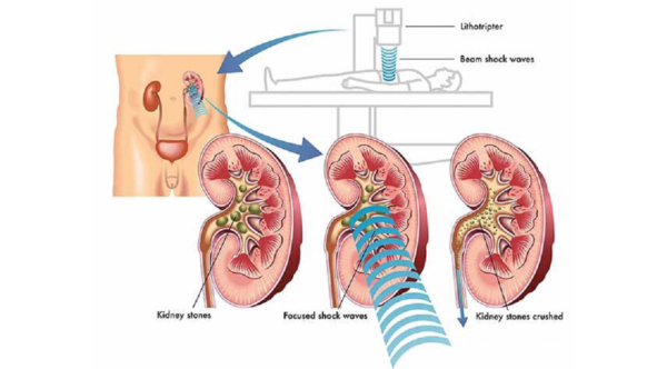 Tán sỏi thận ngoài cơ thể làm sạch sỏi không cần mổ