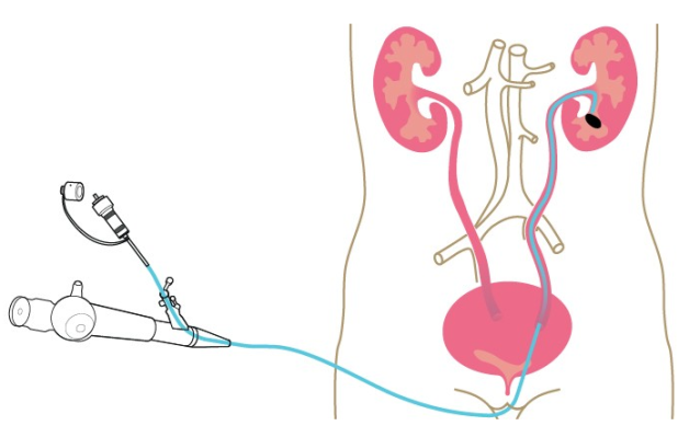 Tán sỏi thận qua nội soi niệu quản ngược dòng, không mổ