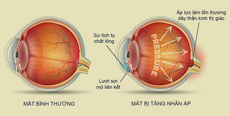 Tăng nhãn áp glocom là gì? Nguy hiểm như thế nào?