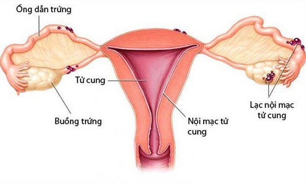 Tăng sản nội mạc tử cung: Nguyên nhân, triệu chứng