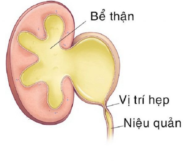 Tạo hình bể thận điều trị bệnh lý hẹp khúc nối bể thận-niệu quản