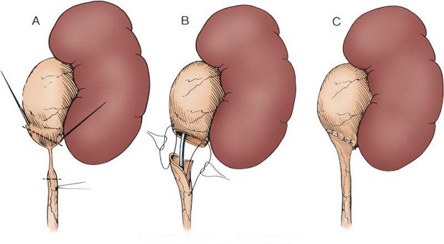 Tạo hình bể thận điều trị bệnh lý hẹp khúc nối bể thận-niệu quản