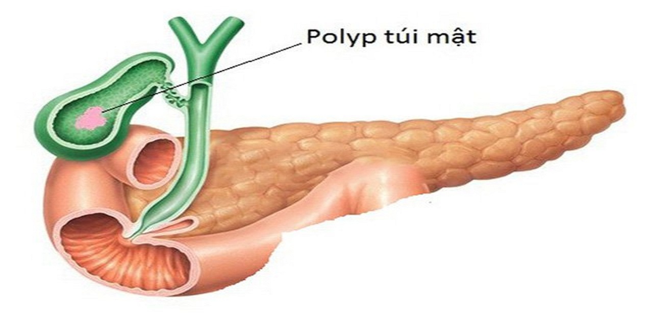 Tất cả những điều bạn cần biết về polyp túi mật 10mm 