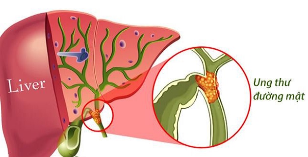 Tất cả những điều bạn cần biết về polyp túi mật 10mm 