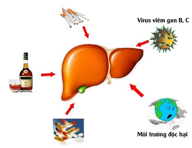 Tất cả những điều bạn cần biết về xơ gan F2