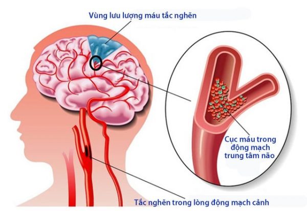 Tất cả những điều cần biết về tai biến mạch máu não