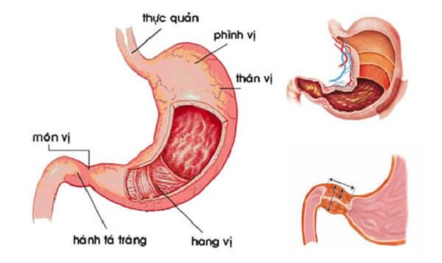 Tất cả những điều cần biết về viêm dạ dày hành tá tràng