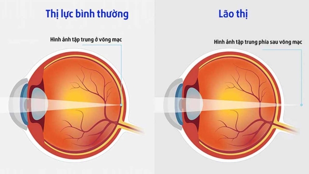 Tất cả những thông tin cần biết về bệnh lão thị