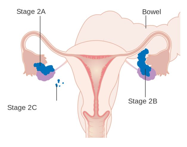 Tất cả thông tin về bệnh ung thư buồng trứng giai đoạn 2