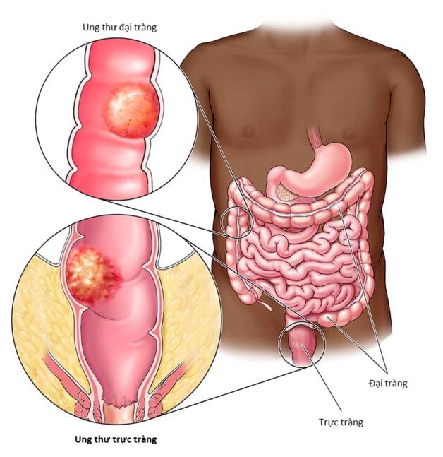 Tất cả thông tin về ung thư trực tràng di căn