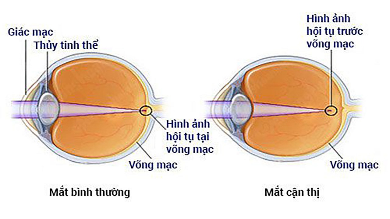 Tật khúc xạ bẩm sinh: Triệu chứng và cách điều trị